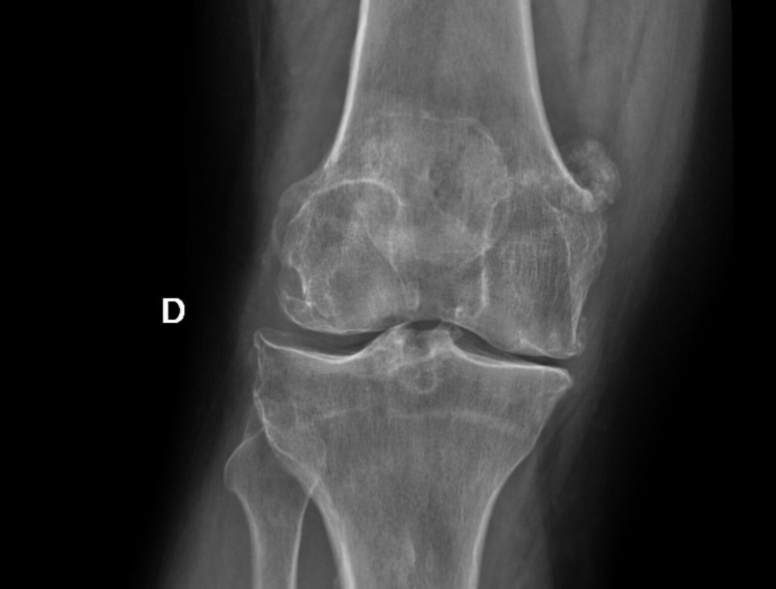 Osteoartritis